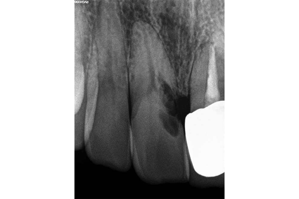 Implant dentaire Strasbourg EMCI 1